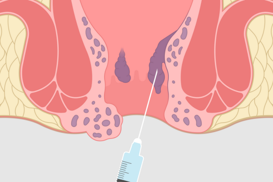 aambei behandeling injectie