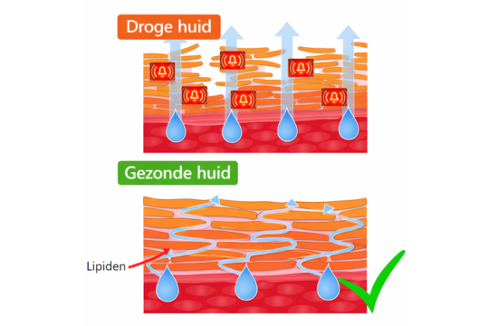 Droge huid VS gezonde huid