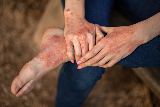 contactallergie handen en voeten