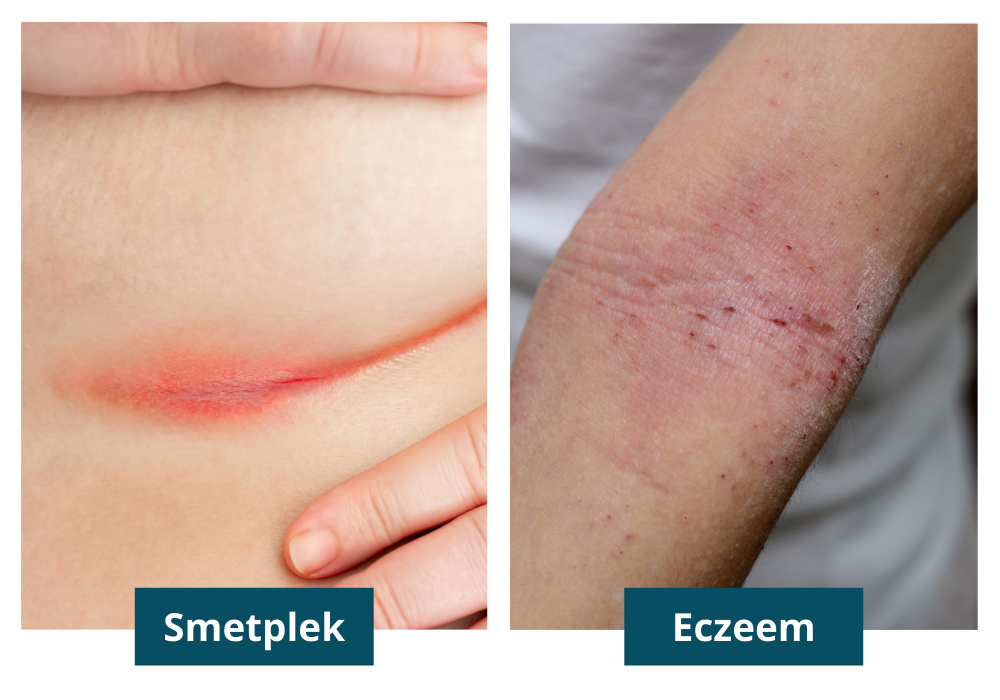 smetplek en eczeem